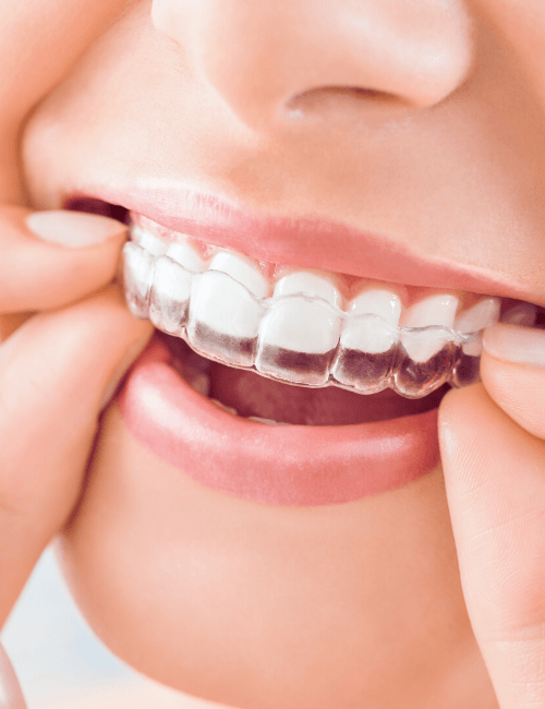 ortodoncia invisible en granada