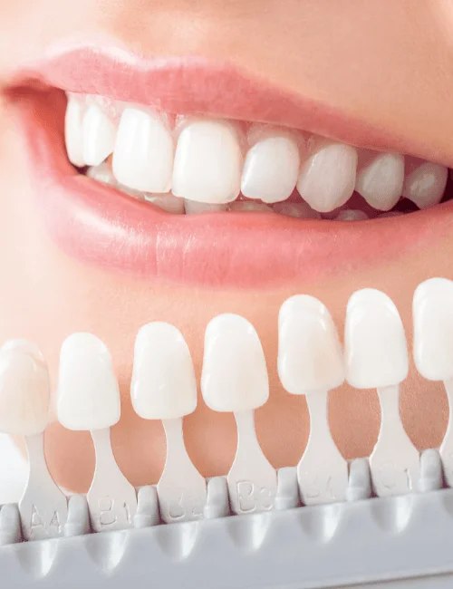 blanqueamiento dental granada