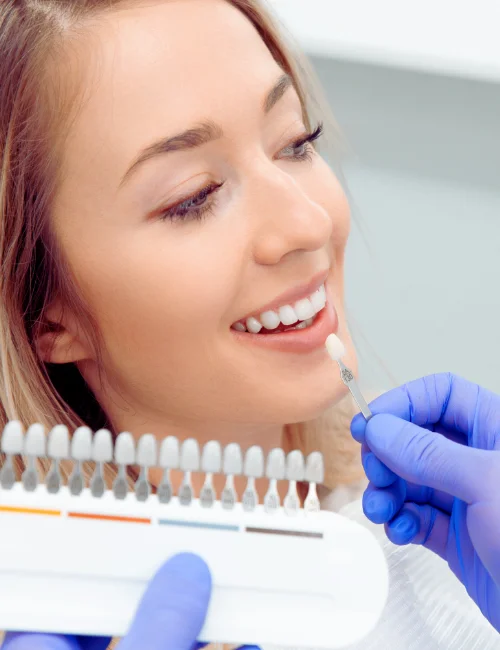 carillas en granada dentista