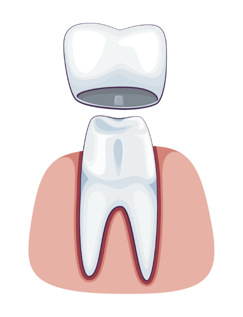 corona dental granada